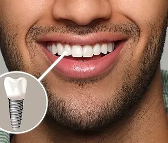 Dental Implants