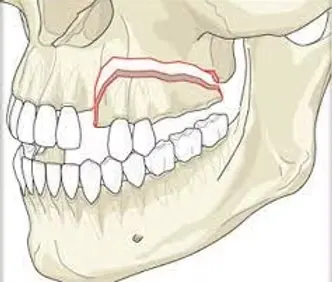 Dentoalveolar Surgery