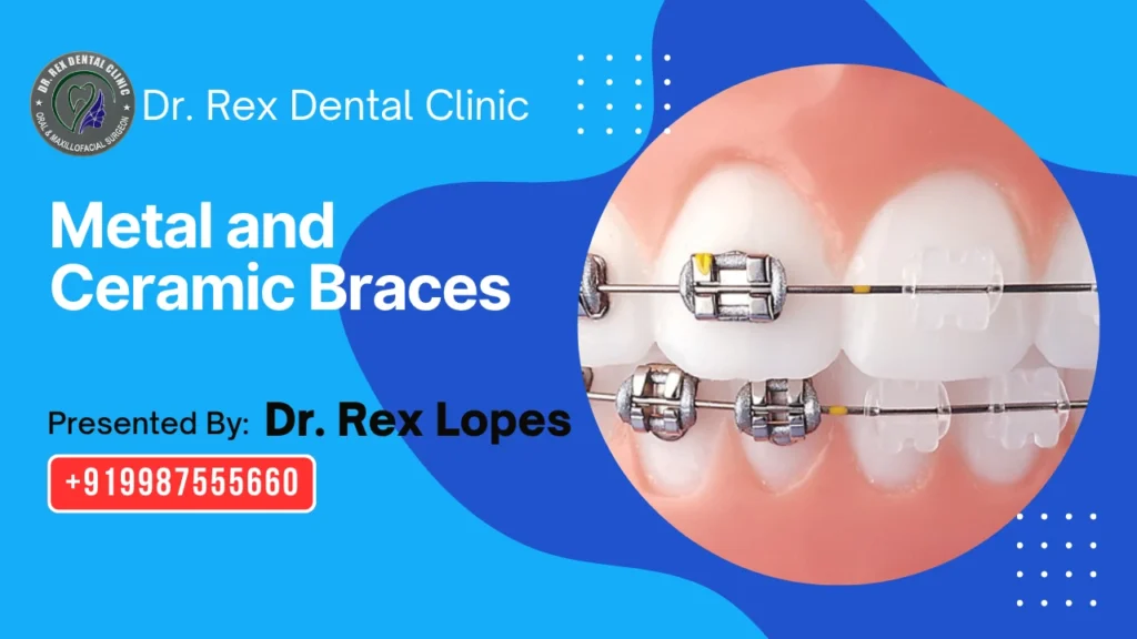 Best Metal and Ceramic Braces in Virar