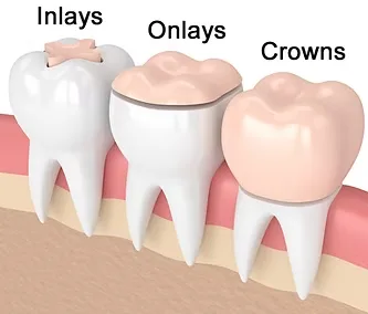 Onlays and Inlays