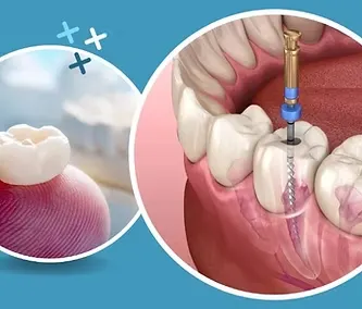 Root Canal Treatment