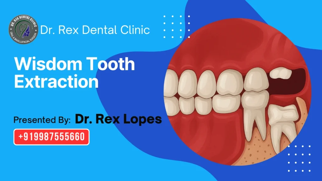 Wisdom Tooth Extraction in Virar