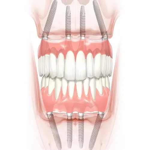 All on 4 Implants