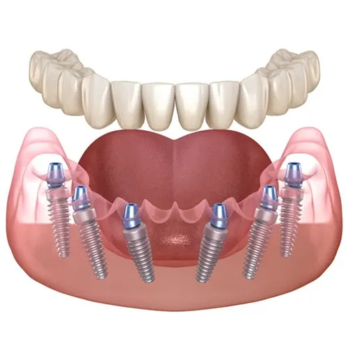 All on 6 implants