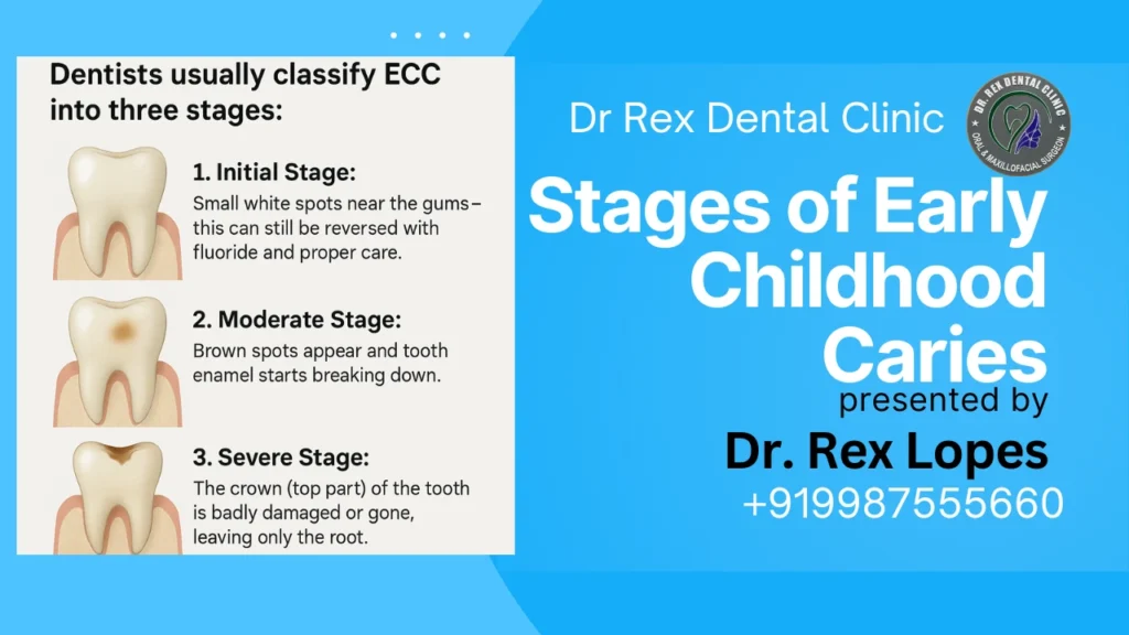 Stages of Early Childhood Caries Dr. Rex Dental Clinic