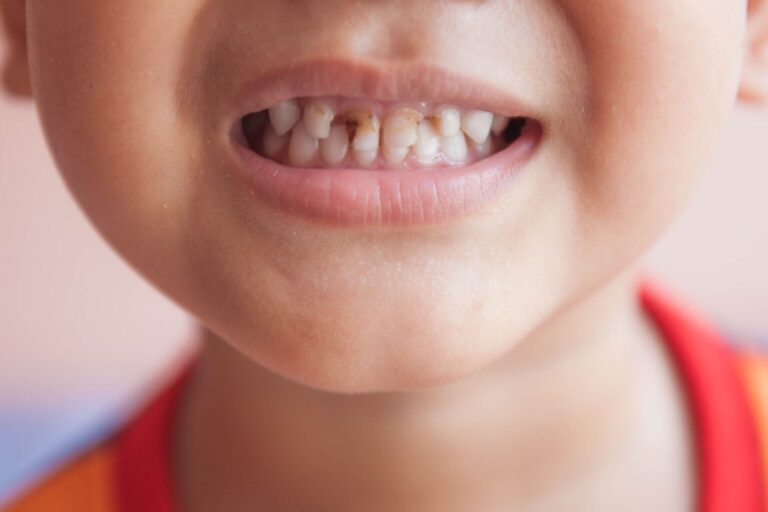 Early childhood caries in Virar
